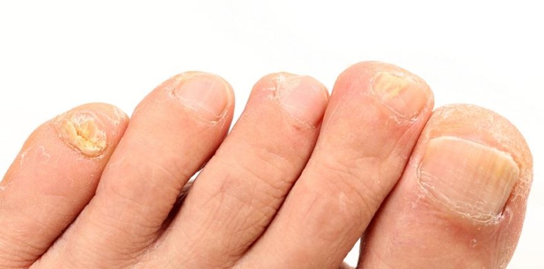 Fuß mit Nagelpilzbefall
